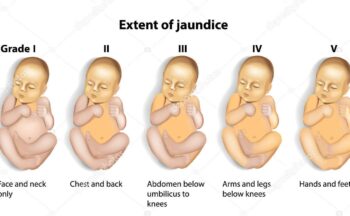Fotografía ilustrativa de la actividad Factores de riesgo que intervienen en el desarrollo de hiperbilirrubinemia neonatal